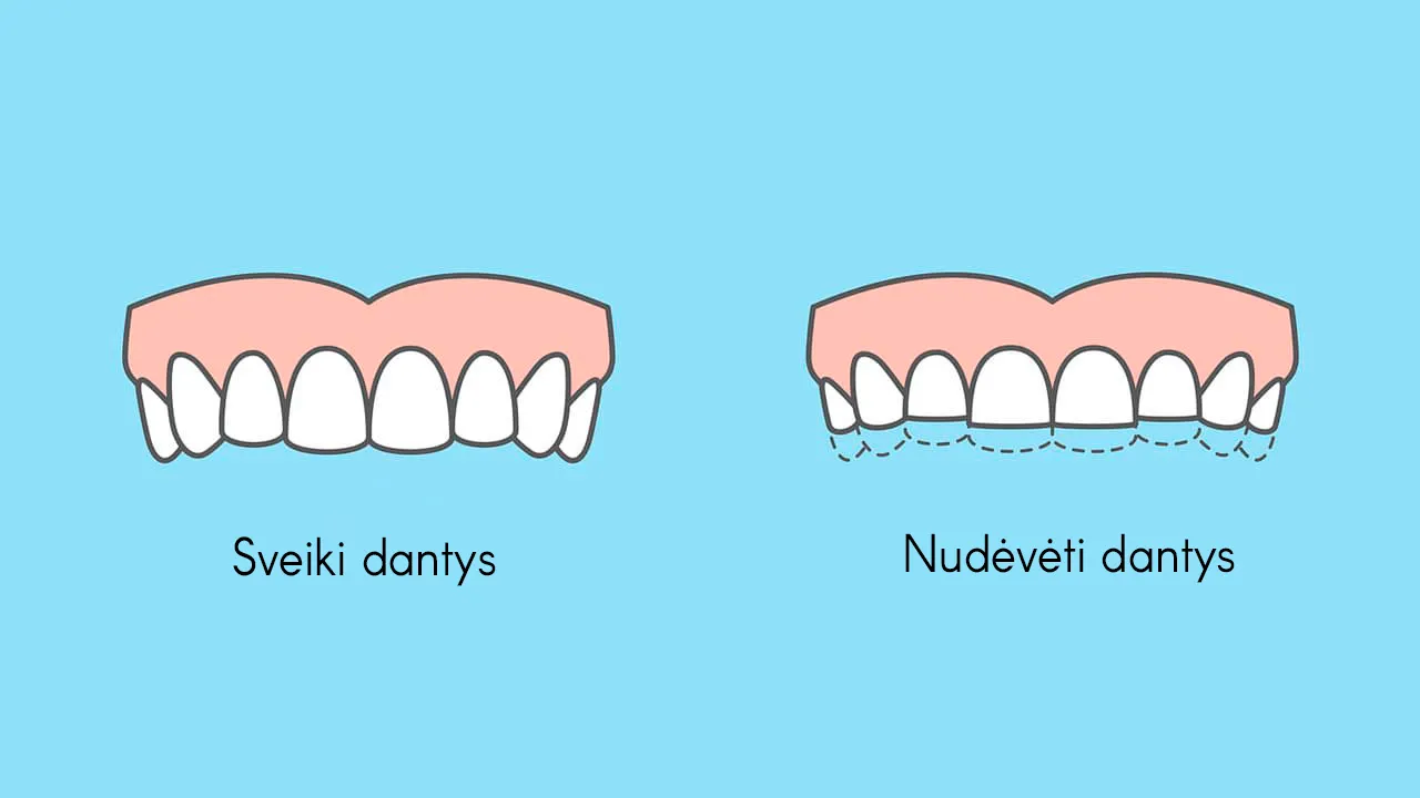 Bruksisma pazīmes: