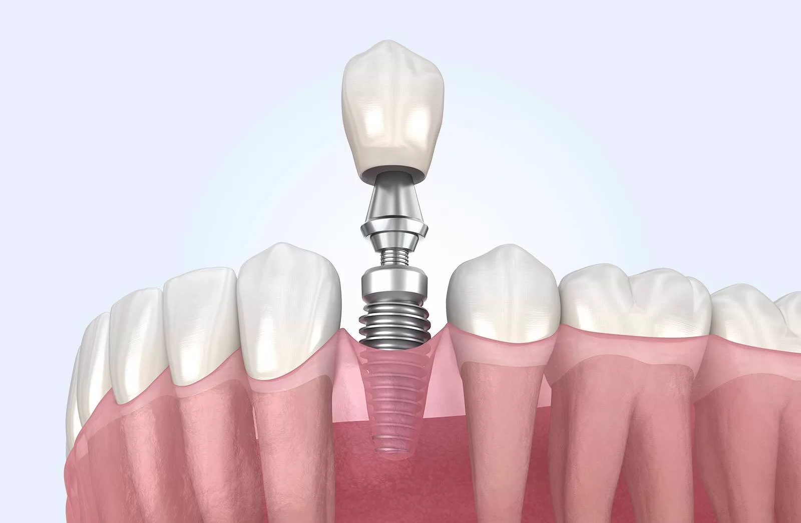 Dantų implantacija “Viskas įskaičiuota”